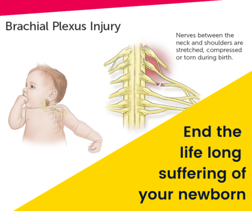 Brachial plexus injury