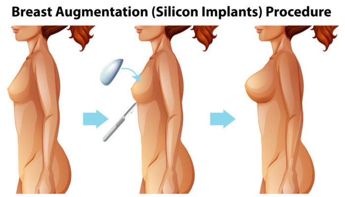 A Vector of Female Breast Implants